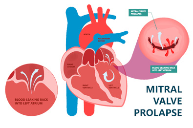 Ayurvedic Treatment For Mitral Valve Prolapse Ayurvedic Treatment For Mitral Valve Prolapse